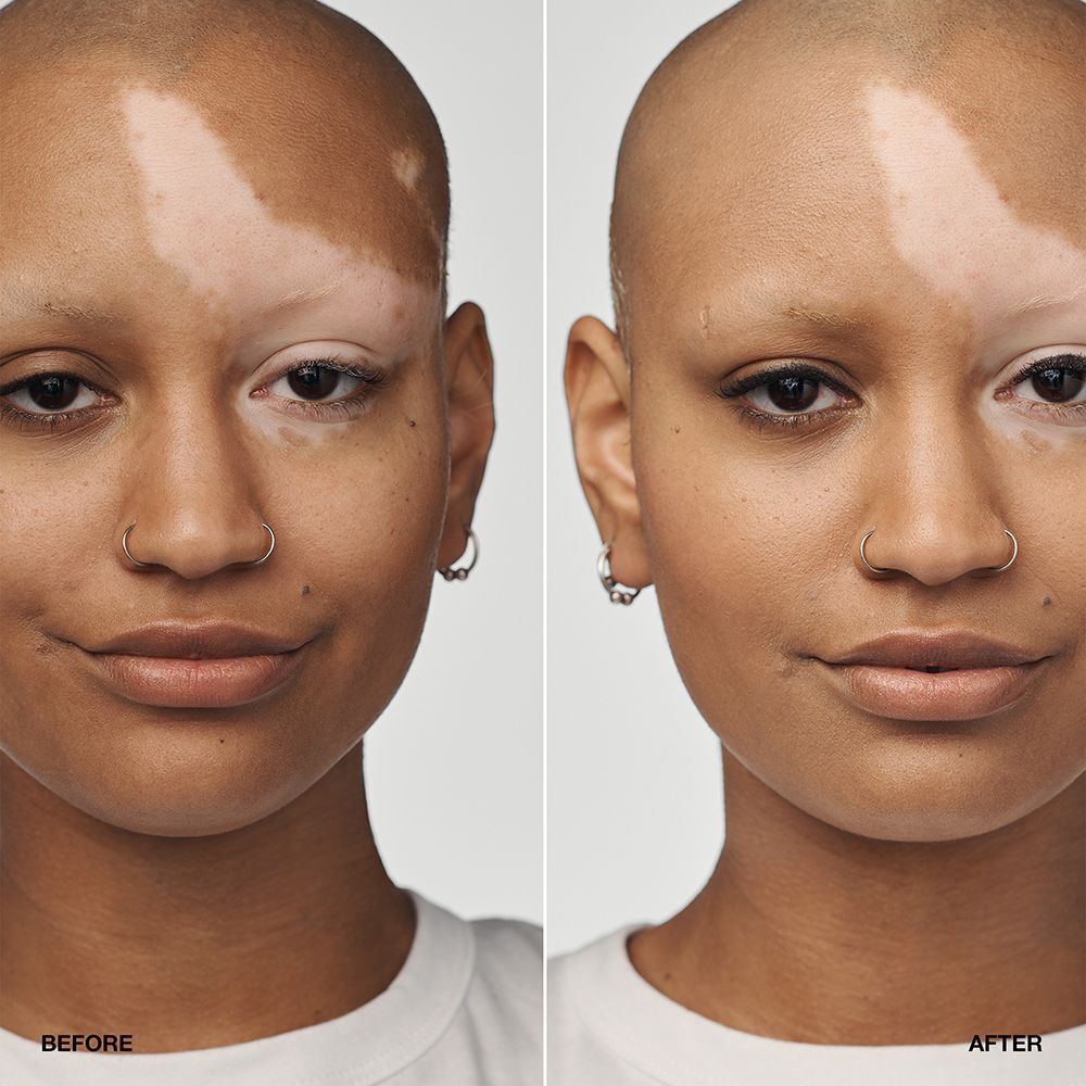 Voor-en-na vergelijking van een persoon met vitiligo die CLINIQUE Even Better Clinical Serum Foundation SPF 20 draagt.