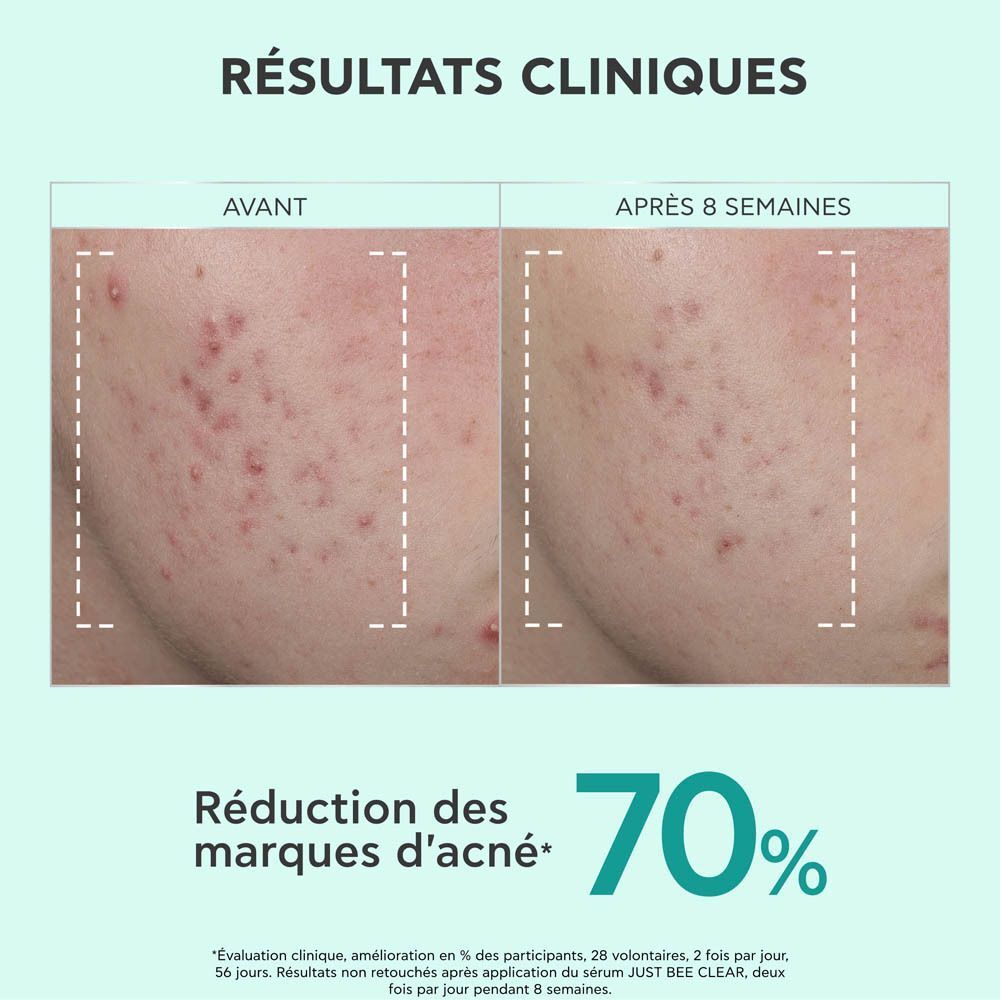 Image avant-après. Visage avec acné. Après 8 semaines: 70% de réduction des marques d'acné.