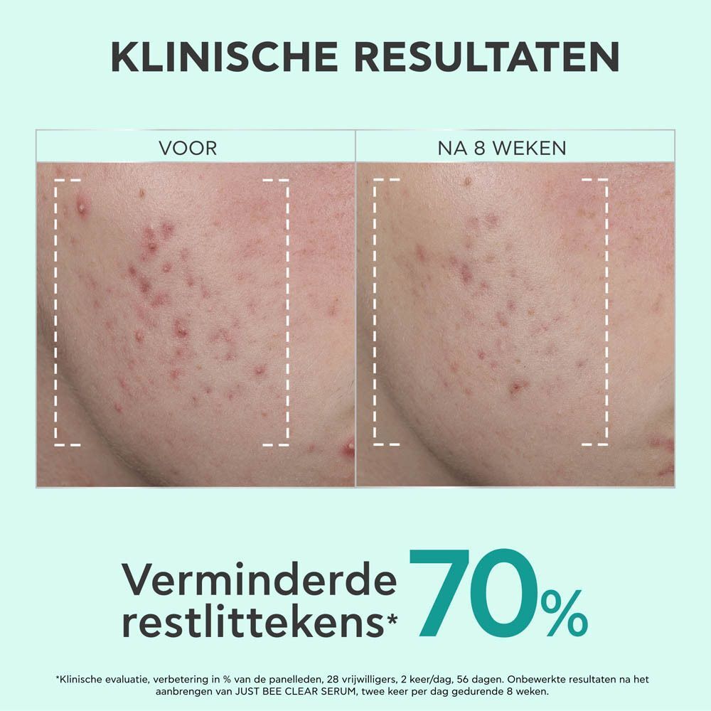 Voor-na foto. Gezicht met acne. Na 8 weken: 70% vermindering van acne littekens.