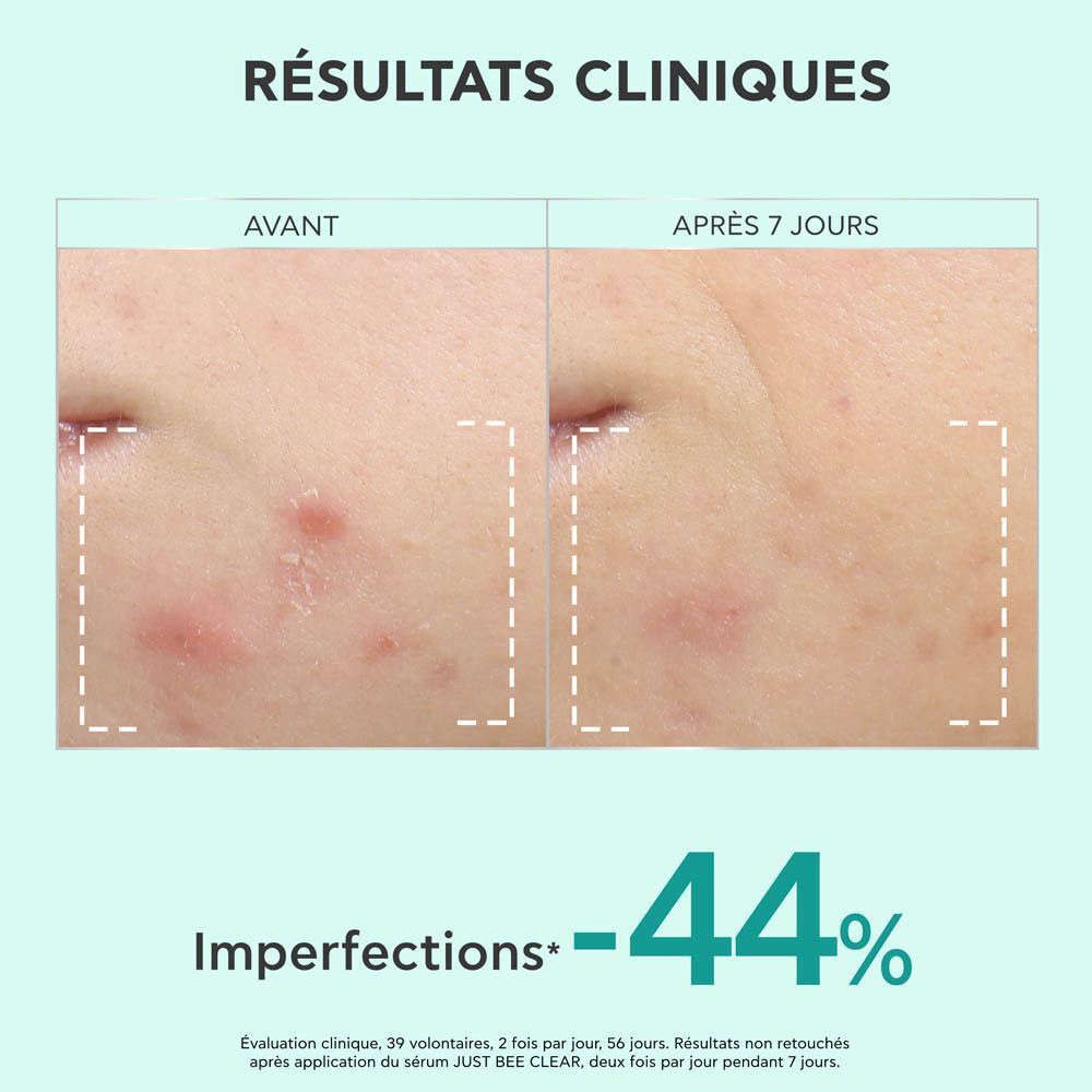 Image avant-après. Visage avec acné. Après 7 jours: -44% d'imperfections.
