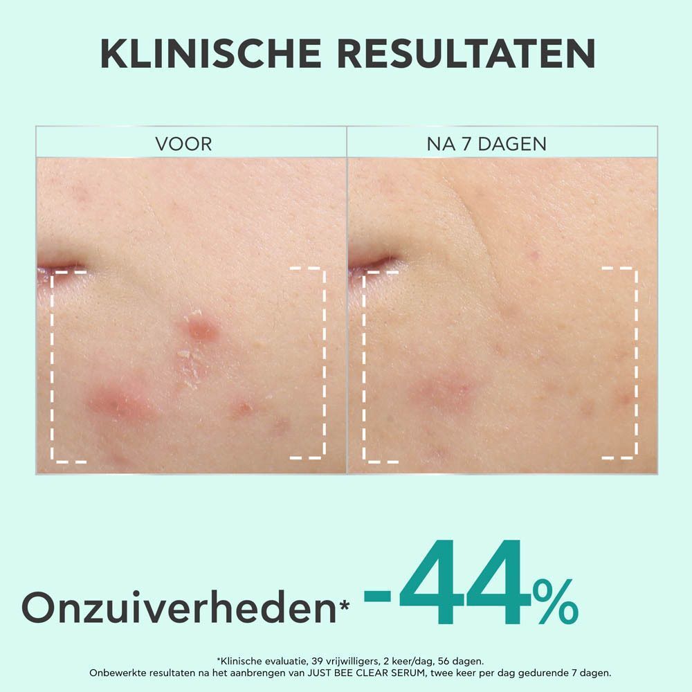 Voor-na foto. Gezicht met acne. Na 7 dagen: -44% onzuiverheden.