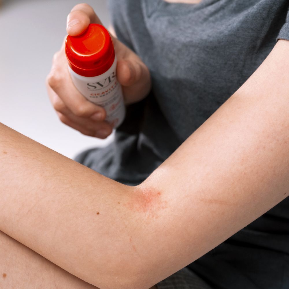 Personne tenant un spray SVR Cicavit+ SOS Grattage. Bouchon rouge, flacon blanc. Éruption cutanée rouge sur le bras.
