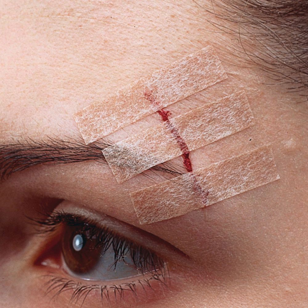 Visage avec une plaie fermée avec trois bandes Nexcare Steri-Strip. Couleur peau.
