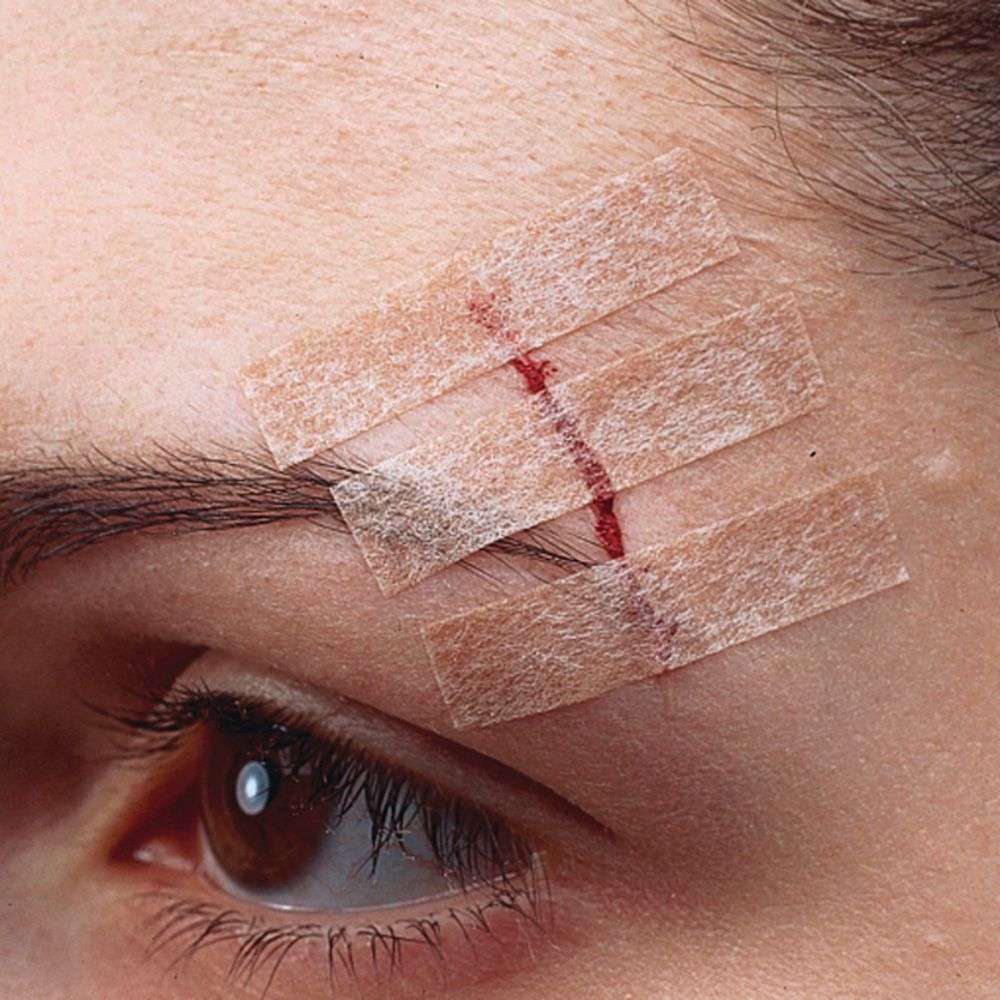 Gezicht met wond, afgesloten met drie Nexcare Steri-Strip strips. Huidkleurig.