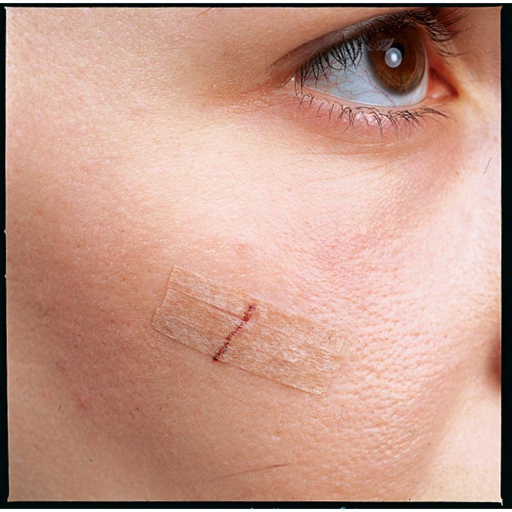 Visage avec une plaie fermée avec une bande Nexcare Steri-Strip. Couleur peau.