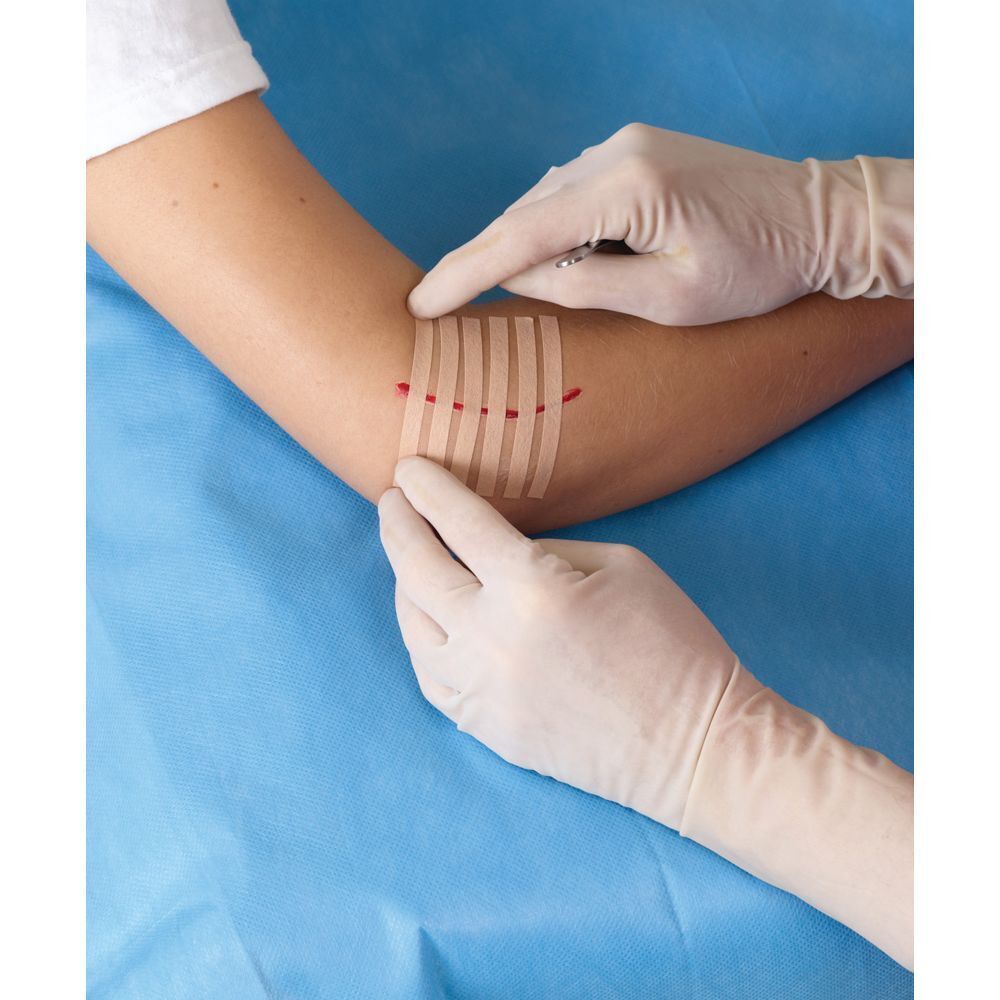 Bras avec une plaie fermée avec des bandes Nexcare Steri-Strip. Gants.