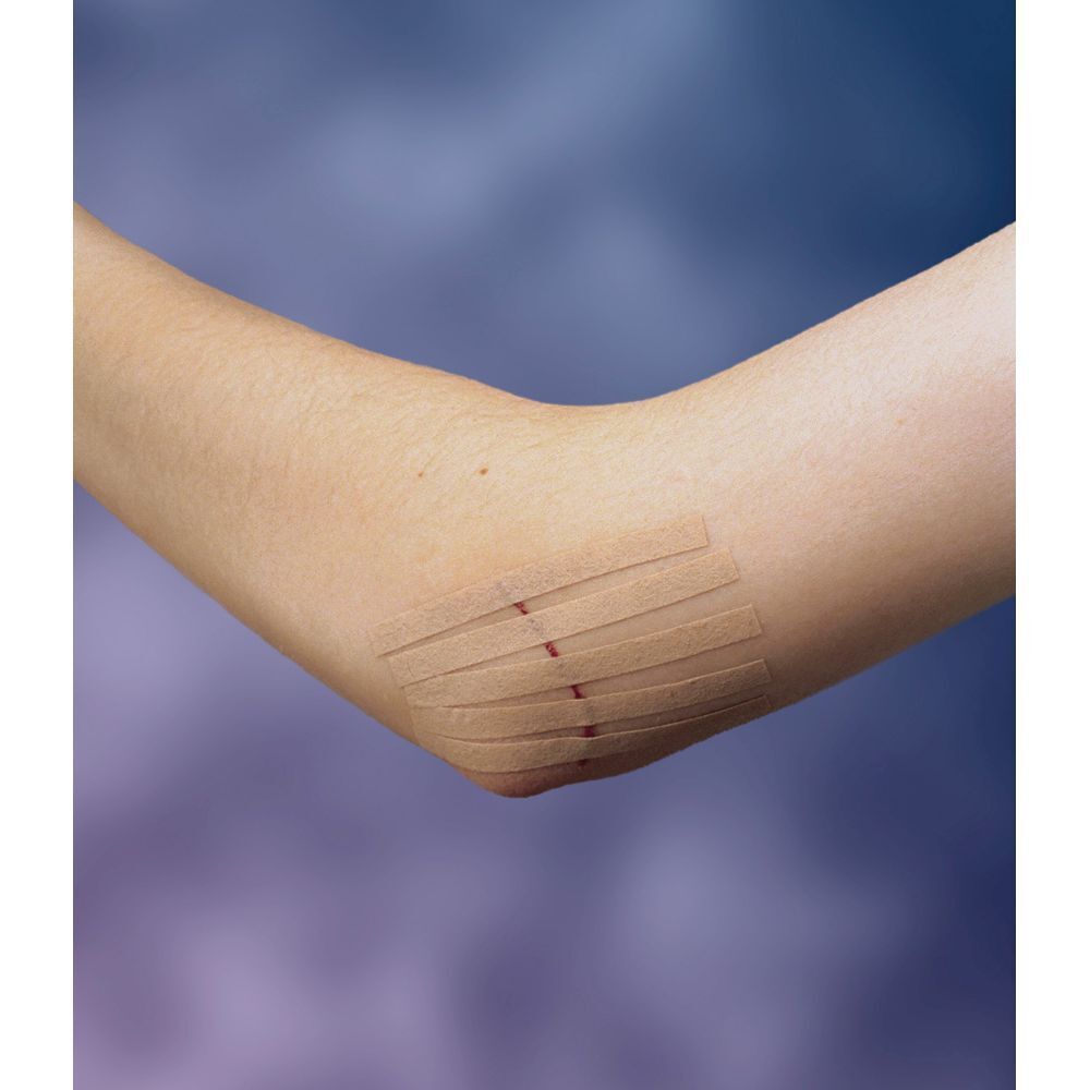 Elleboog met wond, afgesloten met Nexcare Steri-Strip strips. Huidkleurig.