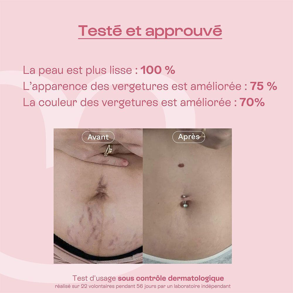 Comparaison avant/après des vergetures avant et après utilisation du produit.