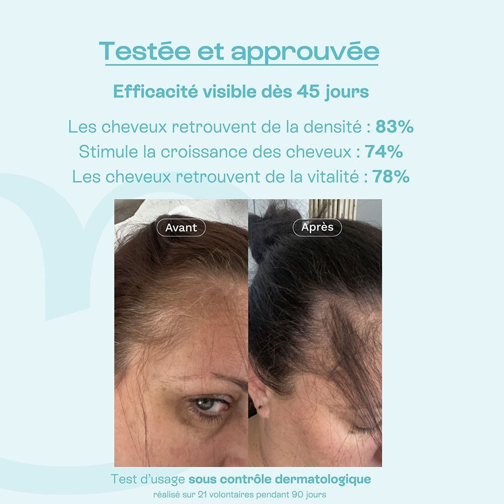 Comparaison avant-après de la densité capillaire après 45 jours d'utilisation de la lotion Omum.