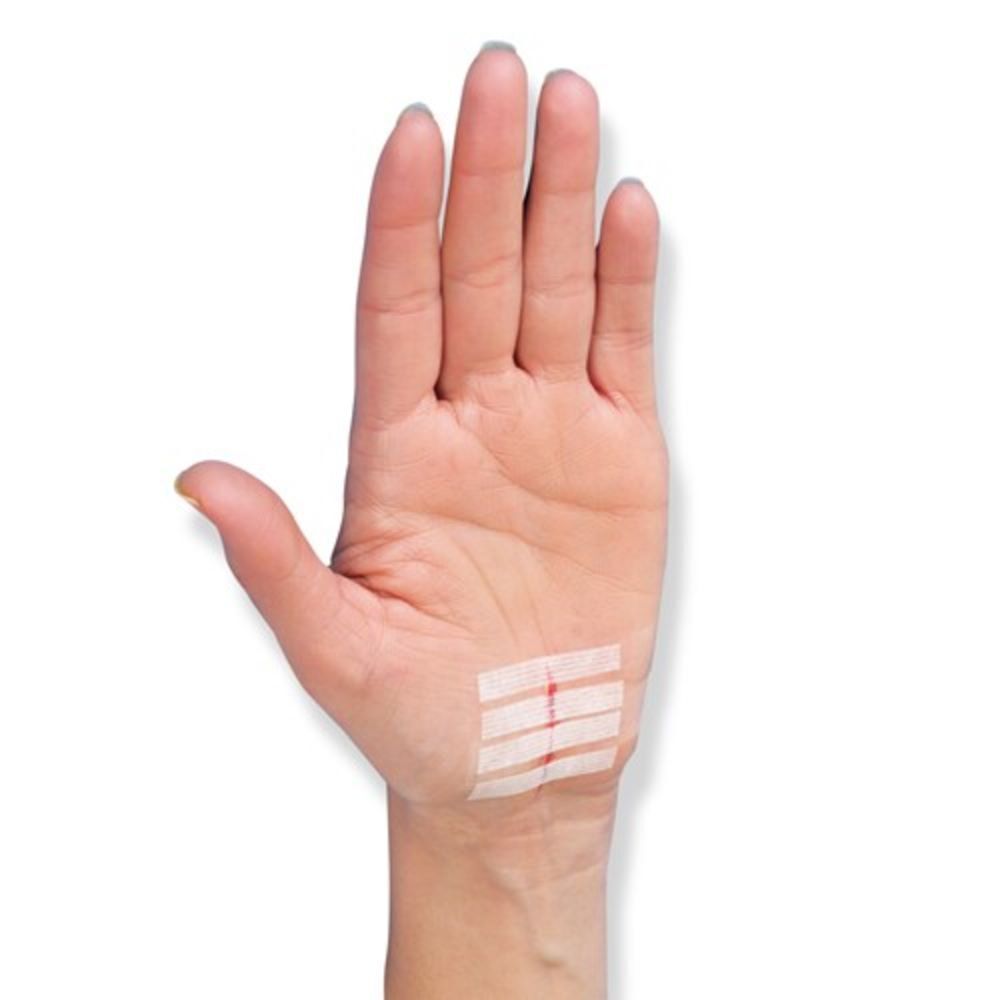 Quatre sutures cutanées Steri-Strip Nexcare sur une paume.