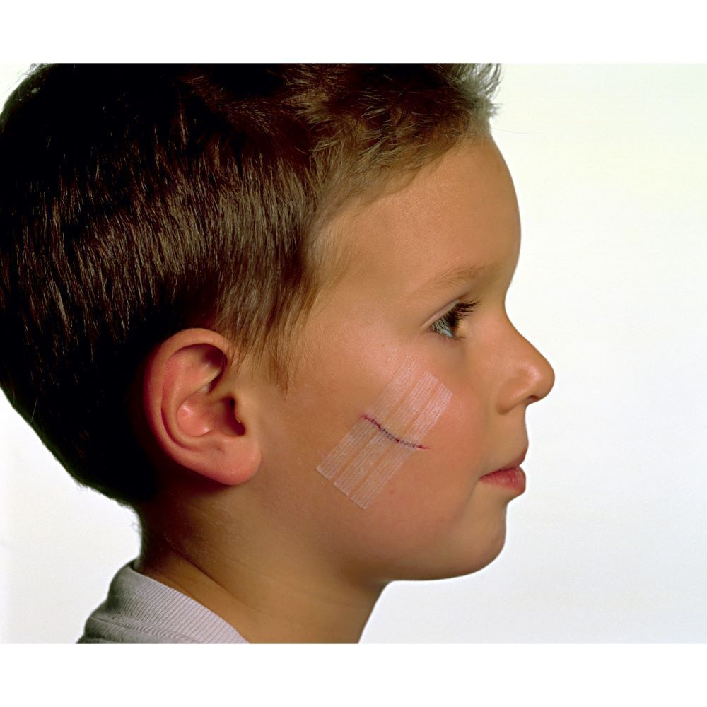 Trois sutures cutanées Steri-Strip Nexcare sur la joue d'un enfant.