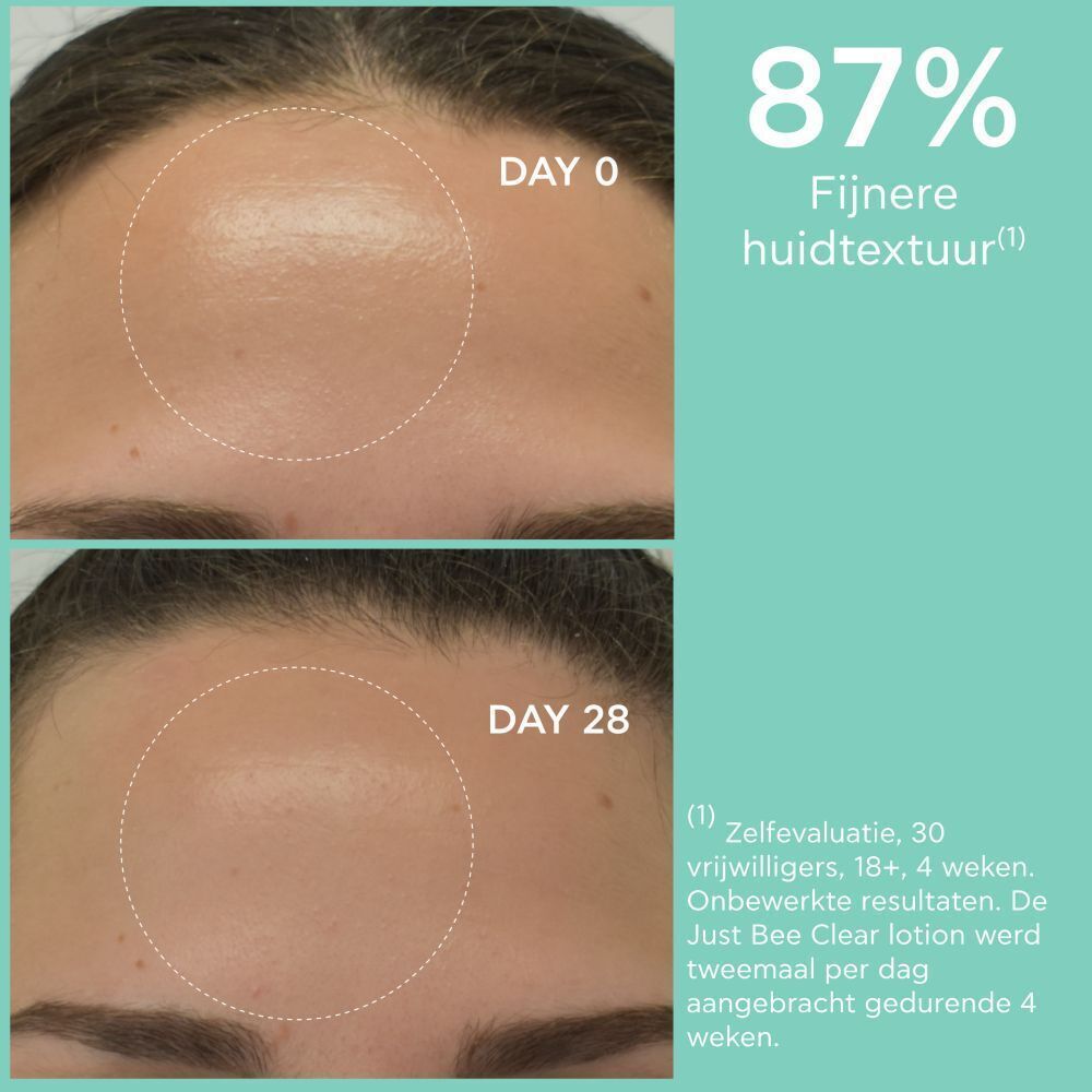 Voor-en-na vergelijking van het voorhoofd na 4 weken gebruik van Apivita Just Bee Clear lotion. Tekst: 'Dag 0', 'Dag 28', '87% fijnere huidtextuur'.