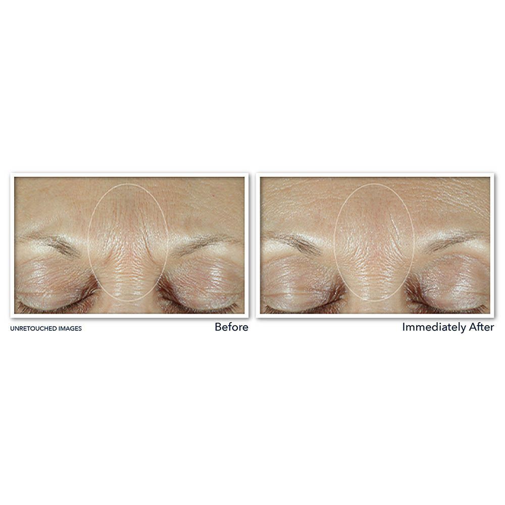 RoC Derm Correxion Serum Fill + Treat