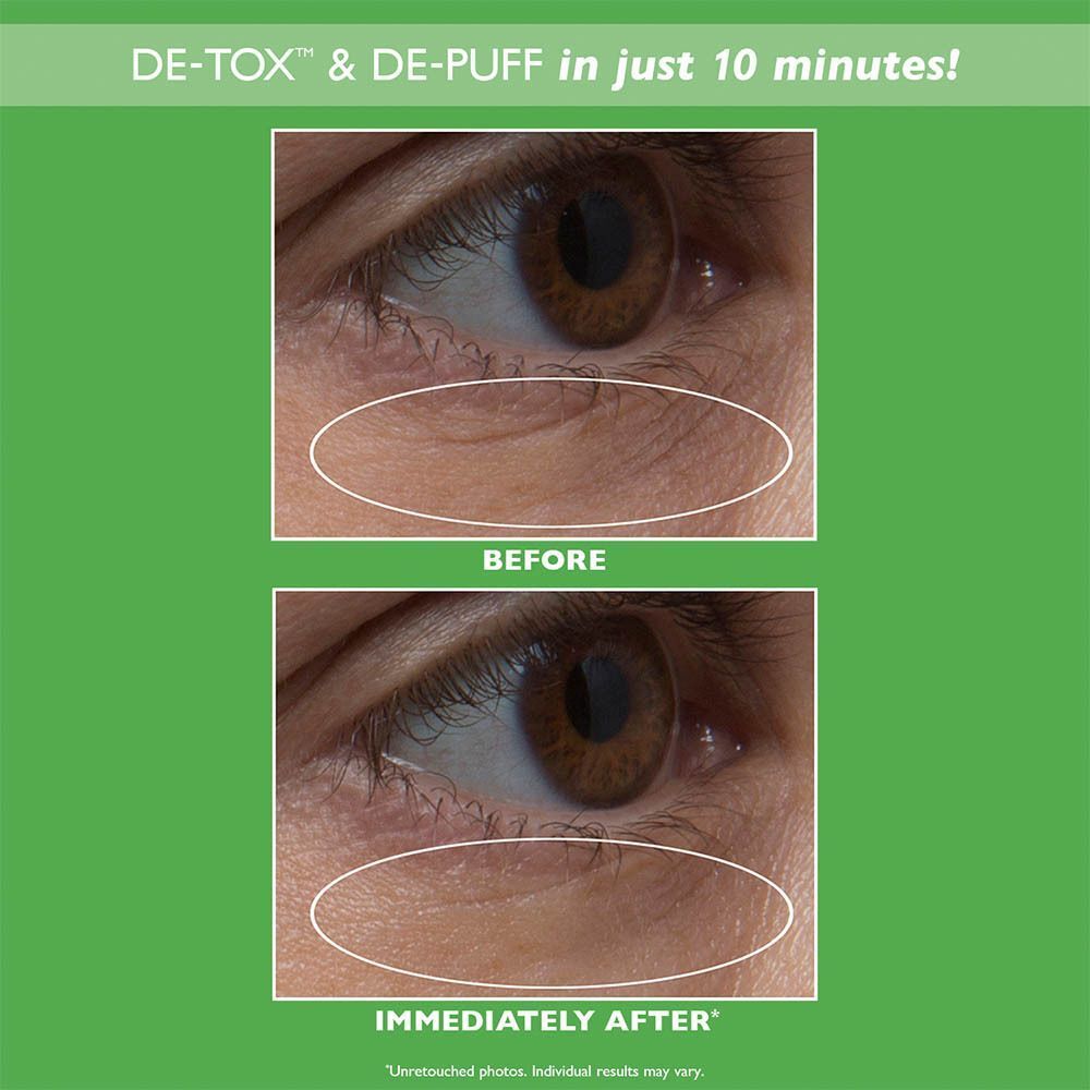 Comparaison avant-après de la zone oculaire, montrant la réduction des ridules.