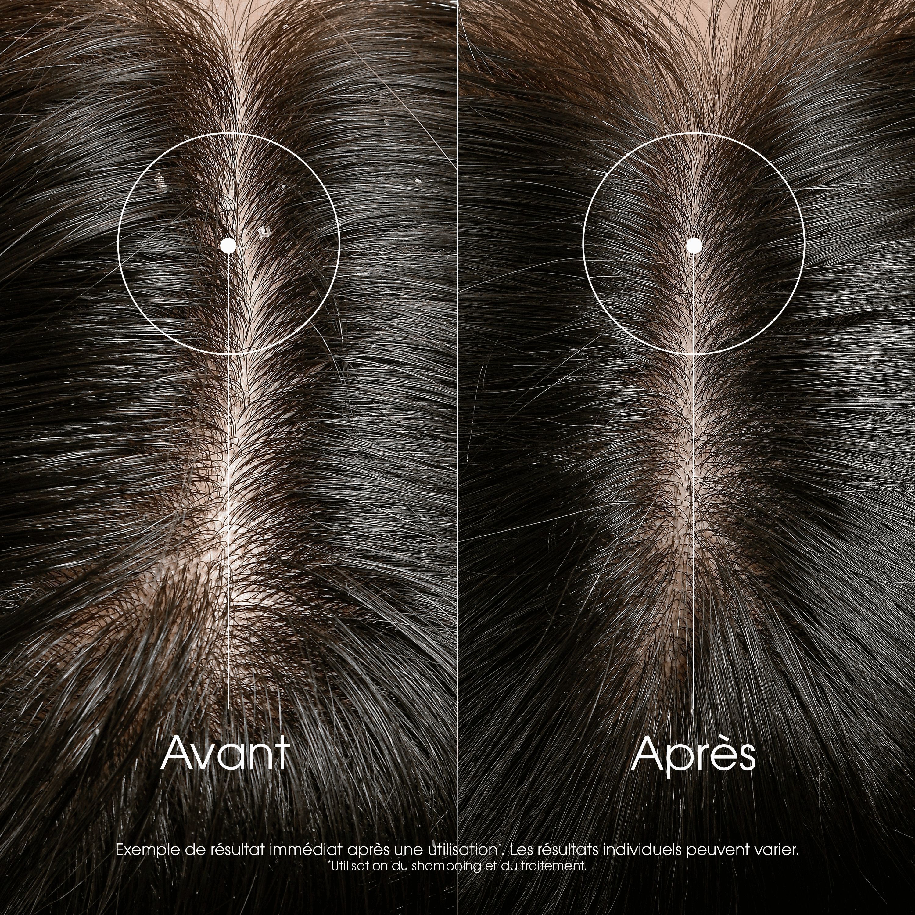 Comparaison du cuir chevelu avant et après l'utilisation du Klorane Traitement Anti-Démangeaisons.