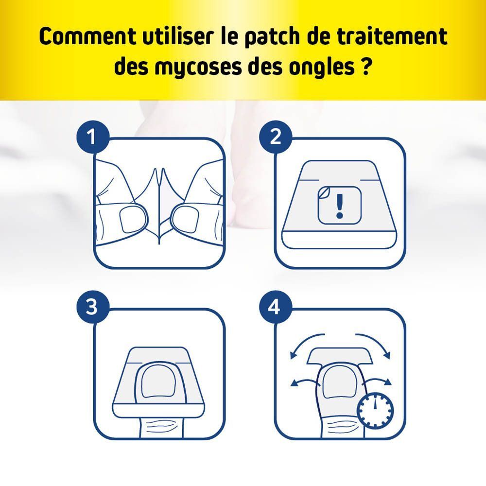 Quatre étapes pour utiliser les patchs Fungex Forte pour mycose des ongles.