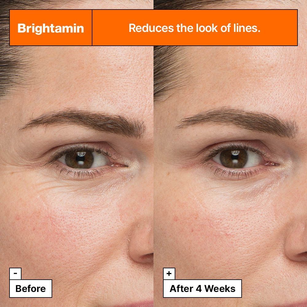 Comparaison avant-après de la peau d'une femme montrant la réduction des ridules.