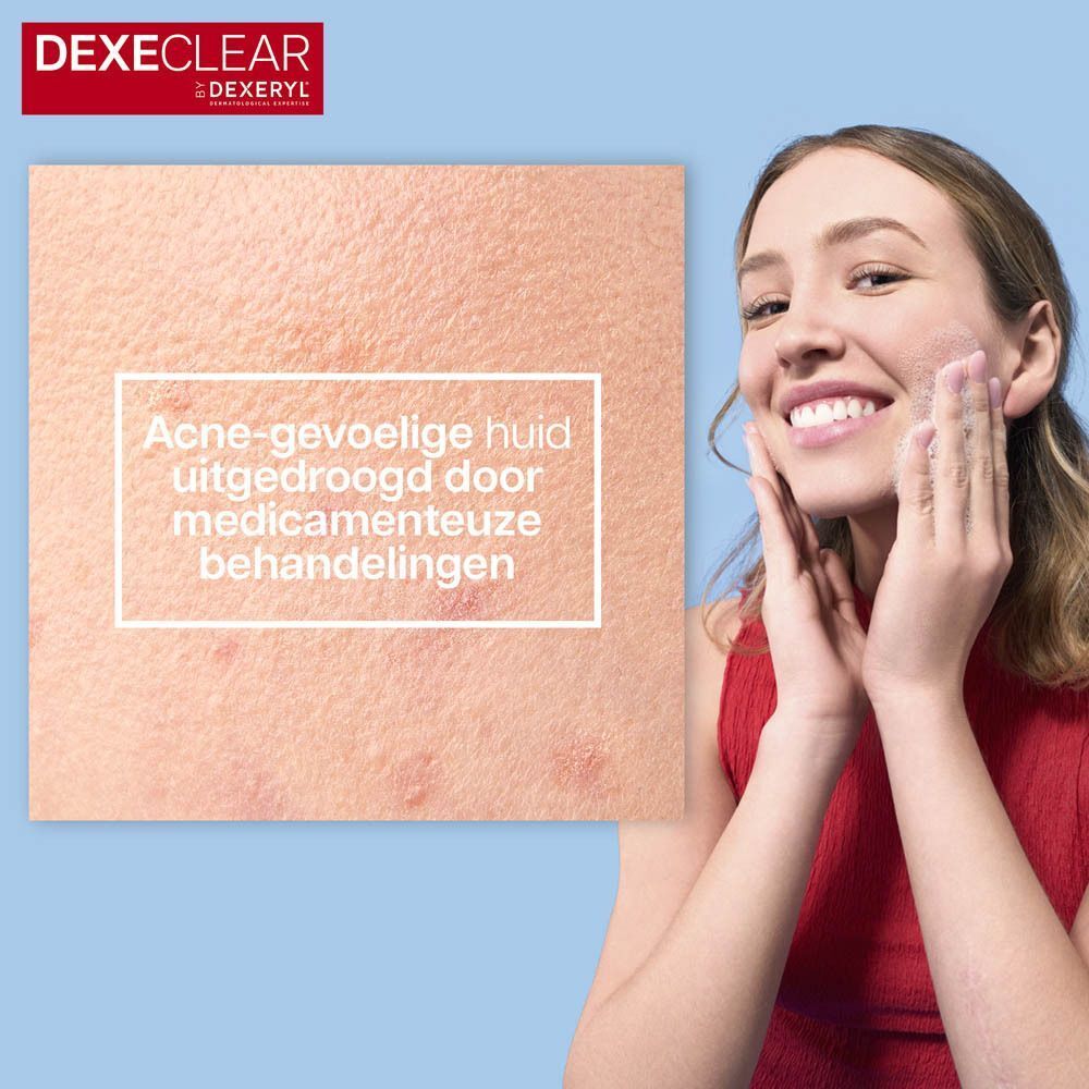 Acne-gevoelige huid uitgedroogd door medicamenteuze behandelingen.