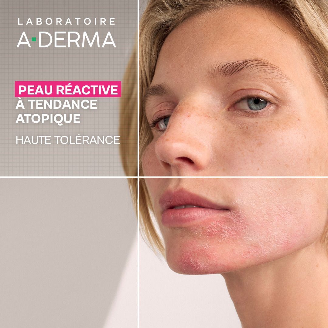 Femme à peau réactive à tendance atopique, haute tolérance.
