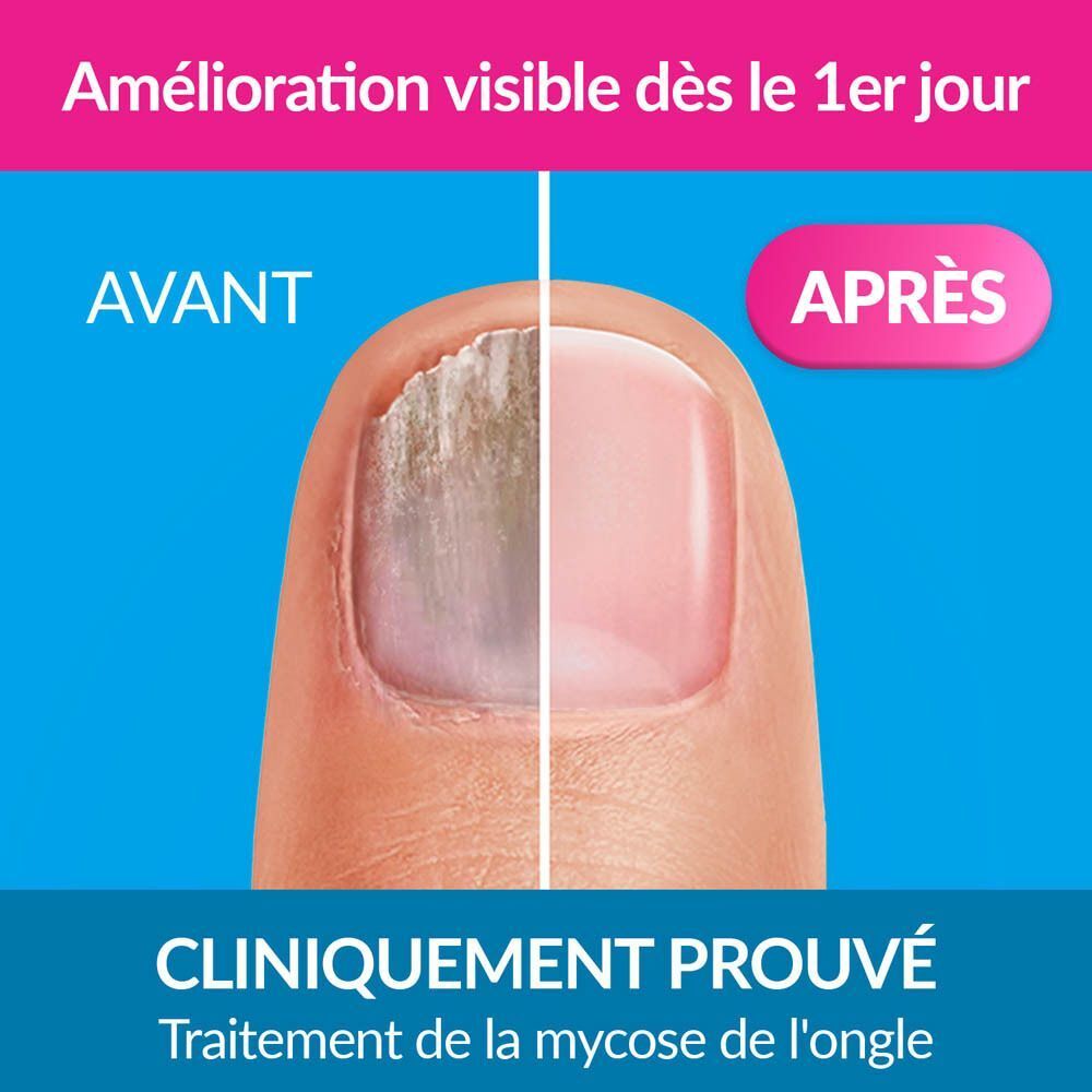 Flacon de traitement pour mycose des ongles Excilor® Forte avec bouchon noir.