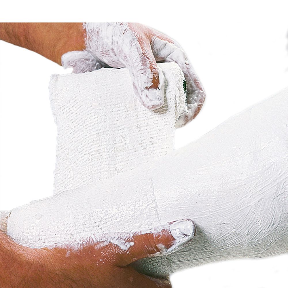 Mains enroulant un bandage de plâtre blanc autour d'une jambe. Le bandage est recouvert de plâtre.