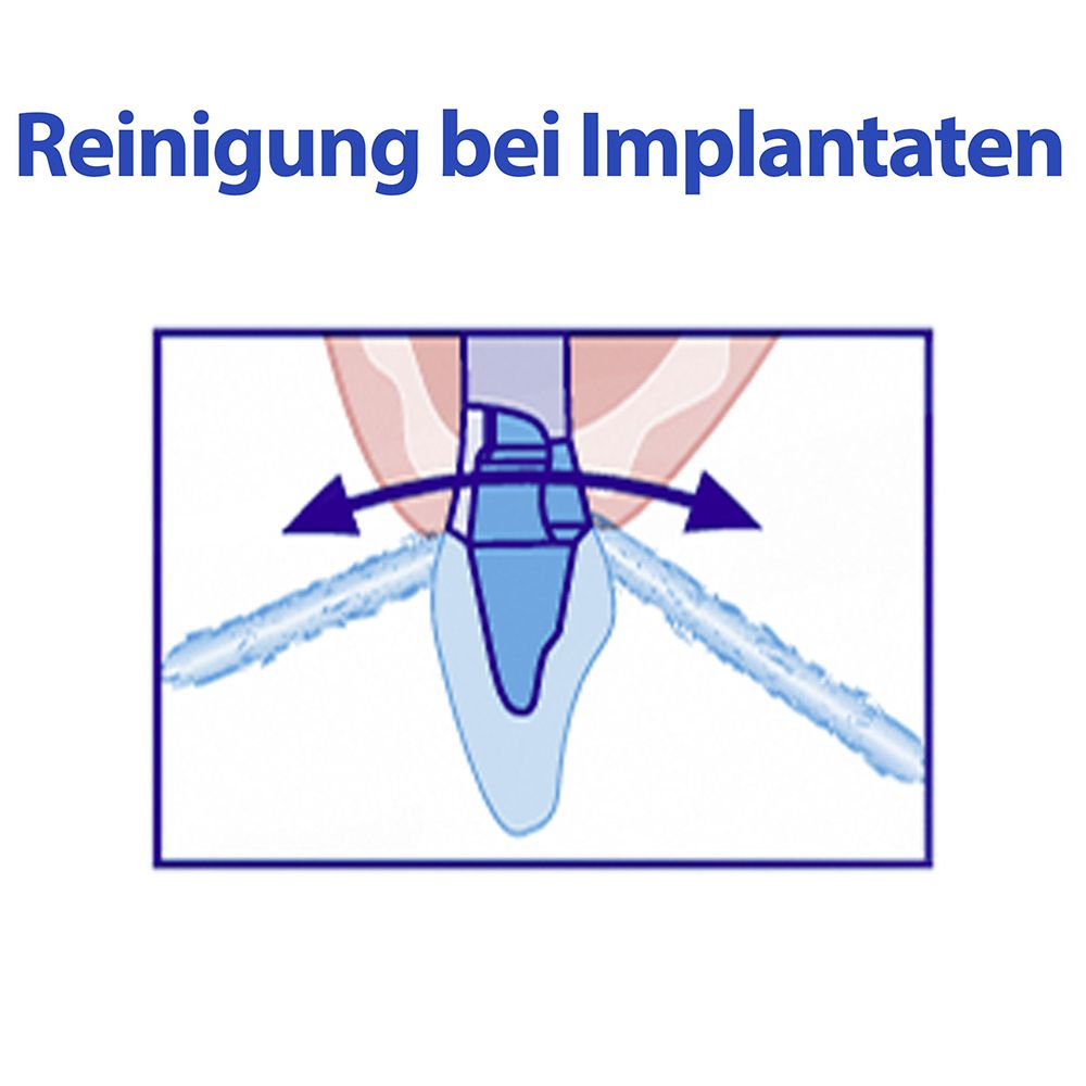 Illustratie: reiniging onder implantaten. Pijlen tonen de beweging van de flossdraad.