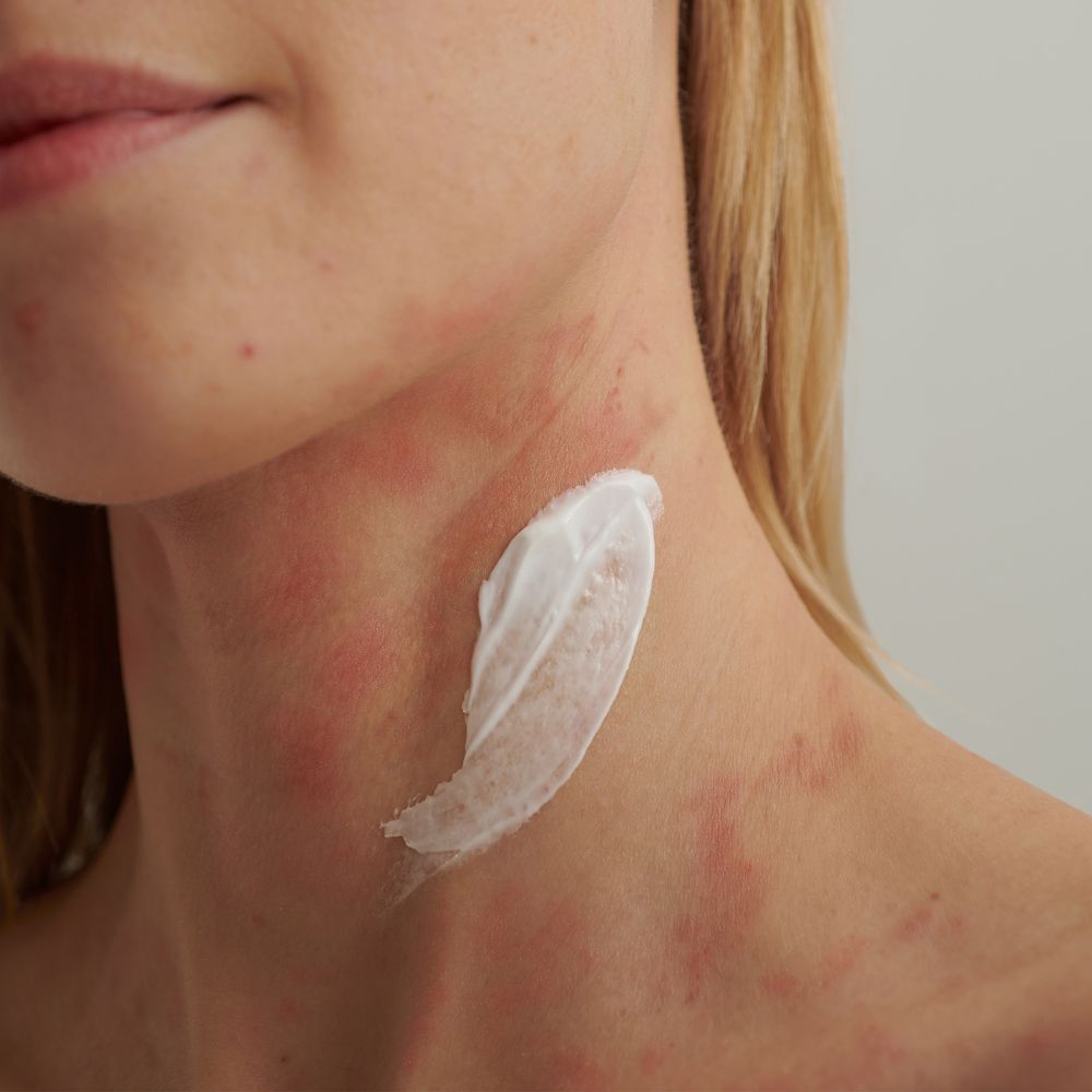 Cou d'une femme avec rougeurs. Crème appliquée.