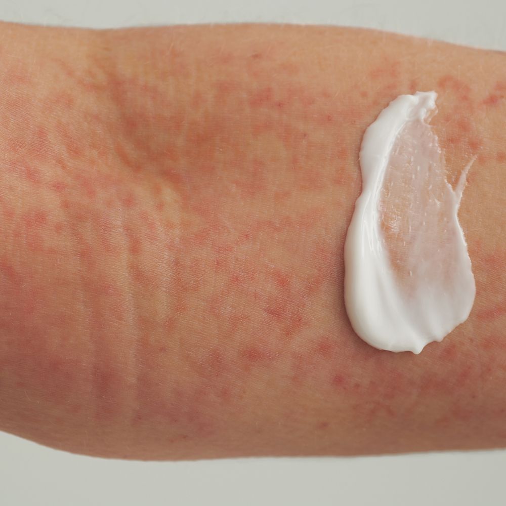 Arm met huiduitslag. Klodder crème op de huid. Crème wit.