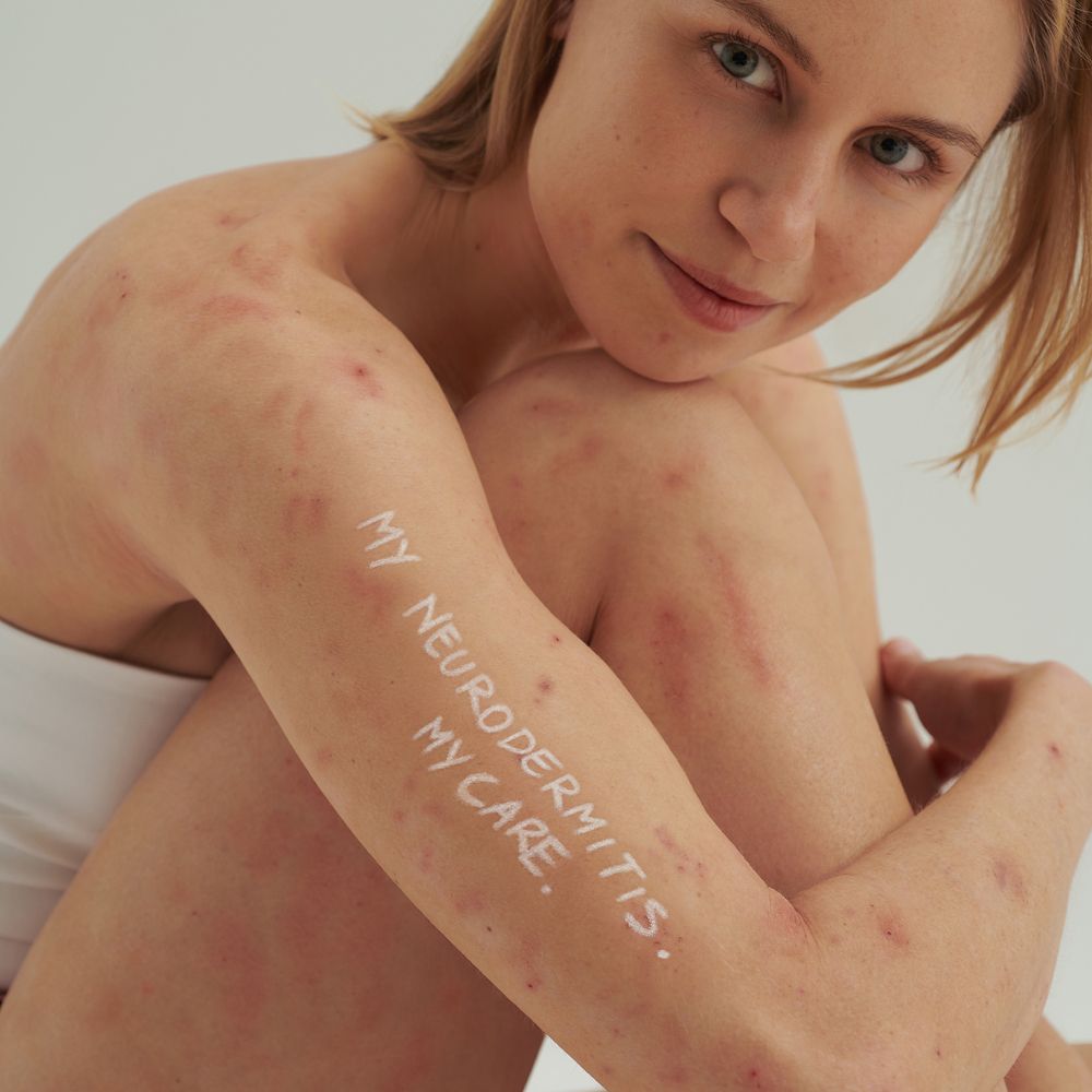 Vrouw met huiduitslag. Op arm staat: MY NEURODERMITIS. MY CARE.