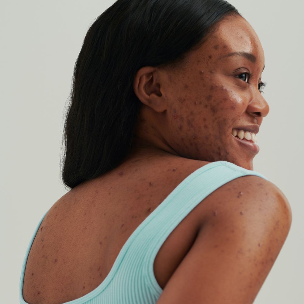 Femme avec imperfections cutanées, souriante. Haut bleu clair. Acné sur le dos et le visage.