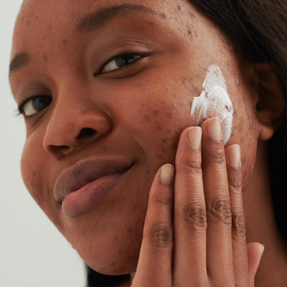 Persoon brengt crème aan op gezicht. Huid met onzuiverheden. Lichte crème wordt aangebracht.