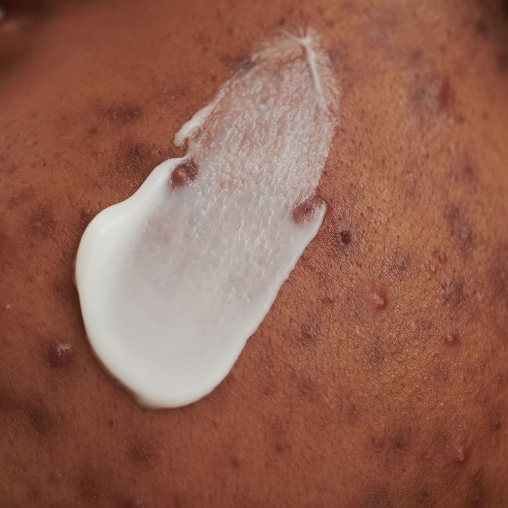 Close-up van crème op huid. Witte crème op donkere huid. Huidonzuiverheden zichtbaar.