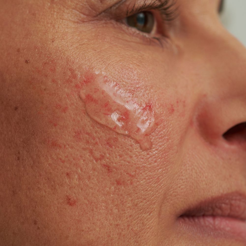 Peau avec liquide clair appliqué. Rougeurs et pores visibles. Gros plan.