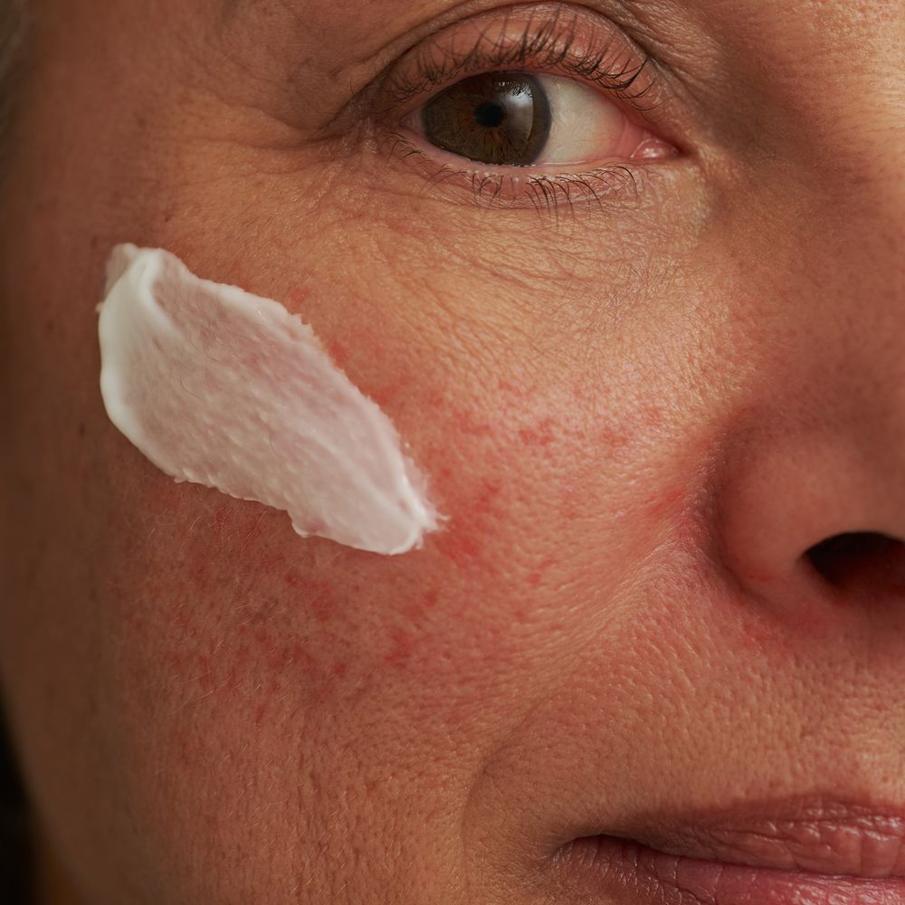Close-up van een gezicht met witte crème op de huid. Roodheid zichtbaar.