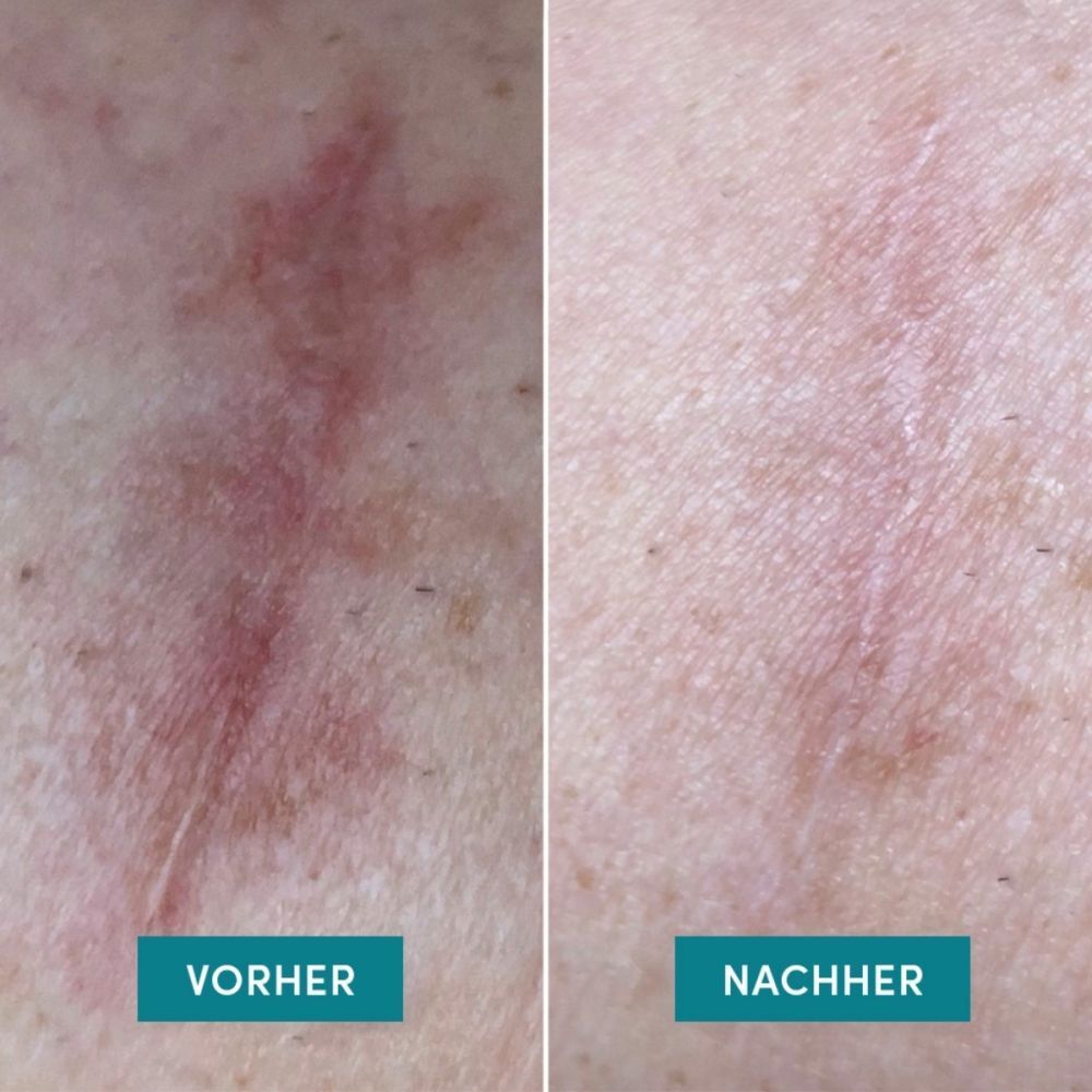 Voor-en-na-vergelijking van een litteken. Links: rood litteken. Rechts: lichter litteken.