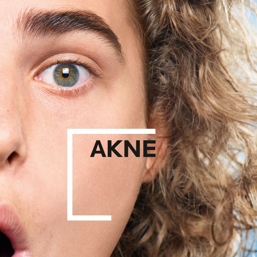 Visage avec acné. Texte : ACNE. Gros plan sur la peau.