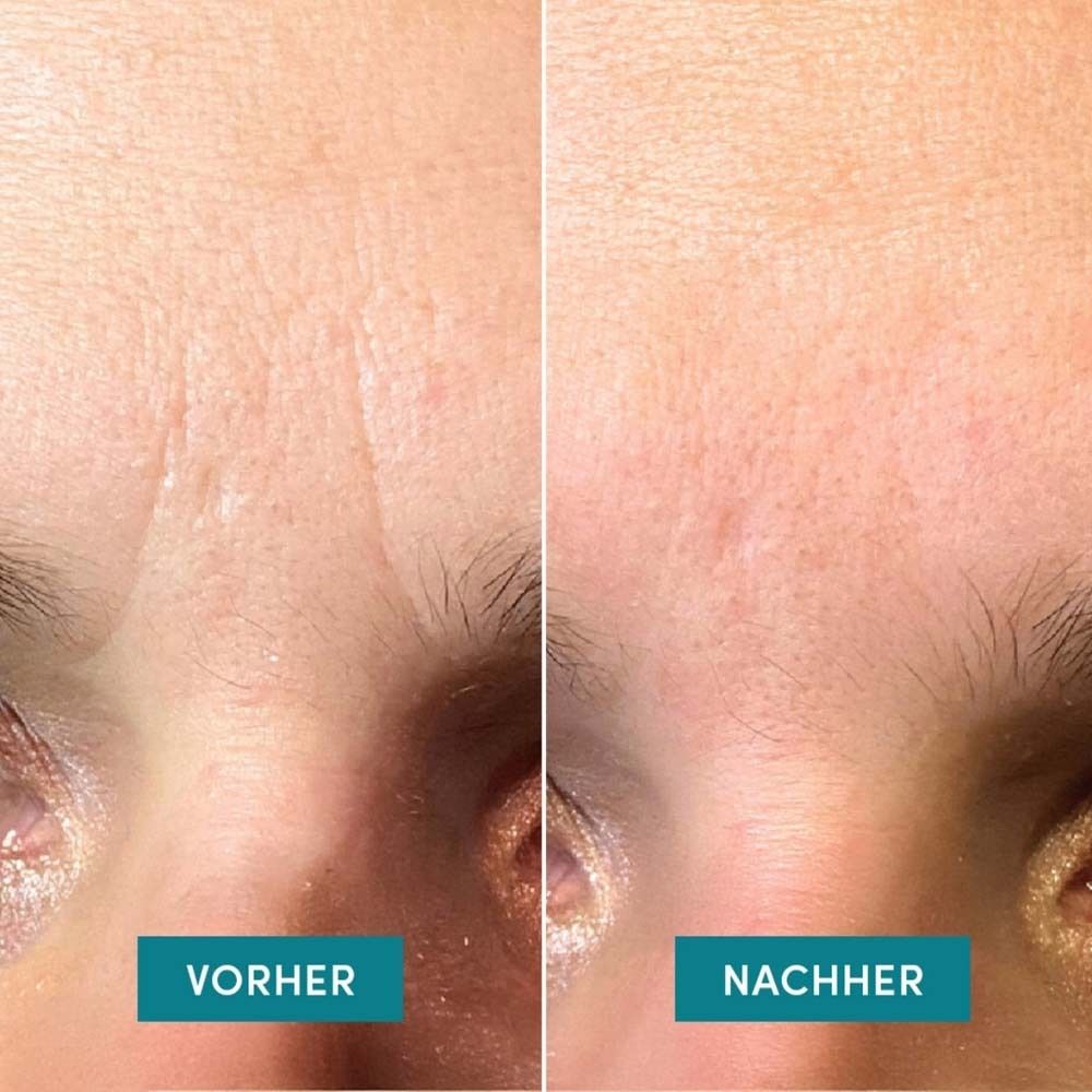 Comparaison avant-après des rides du front. Deux images côte à côte.