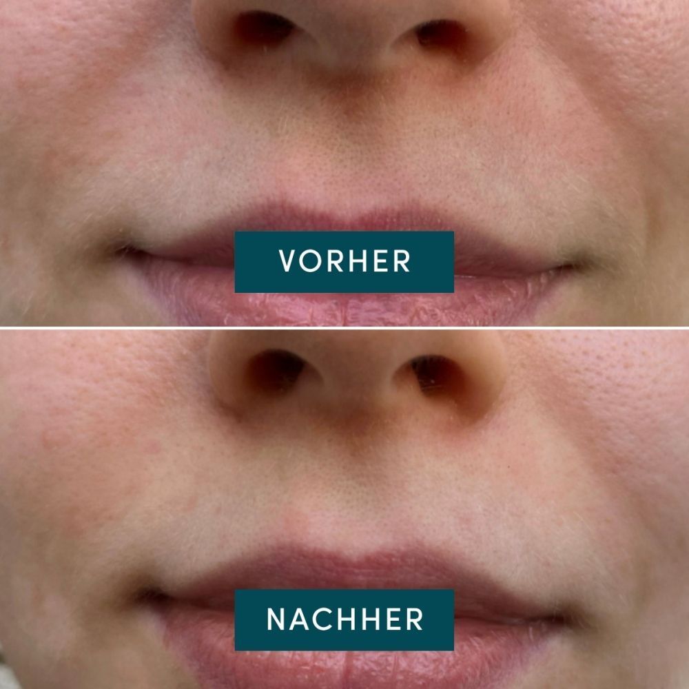 Voor-en-na vergelijking. Bovenste lip: voor. Onderste lip: na.