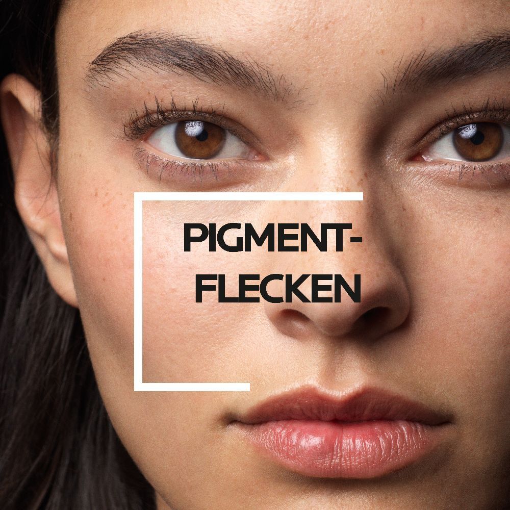 Close-up van een gezicht met een wit kader rond pigmentvlekken.