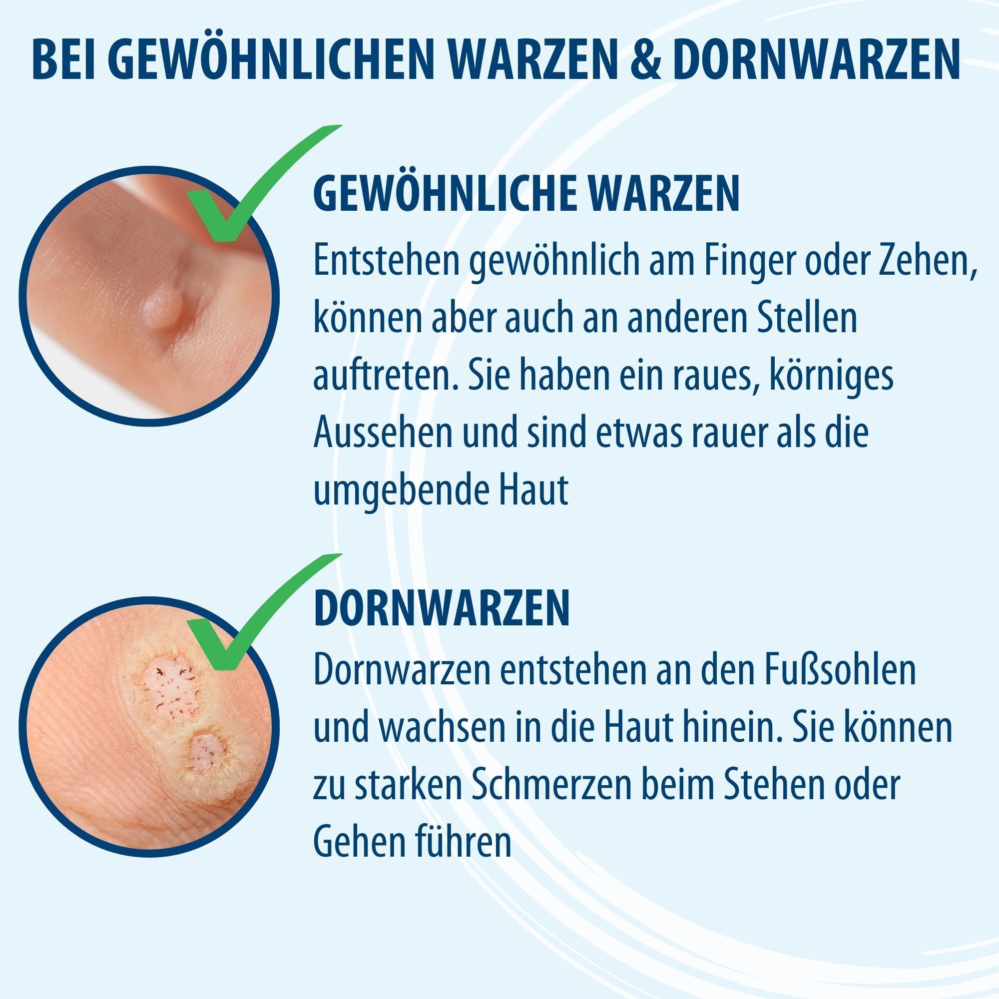 Infographic: Gewone wratten & voetwratten. Illustraties van wratten op de huid. Tekstuele uitleg.