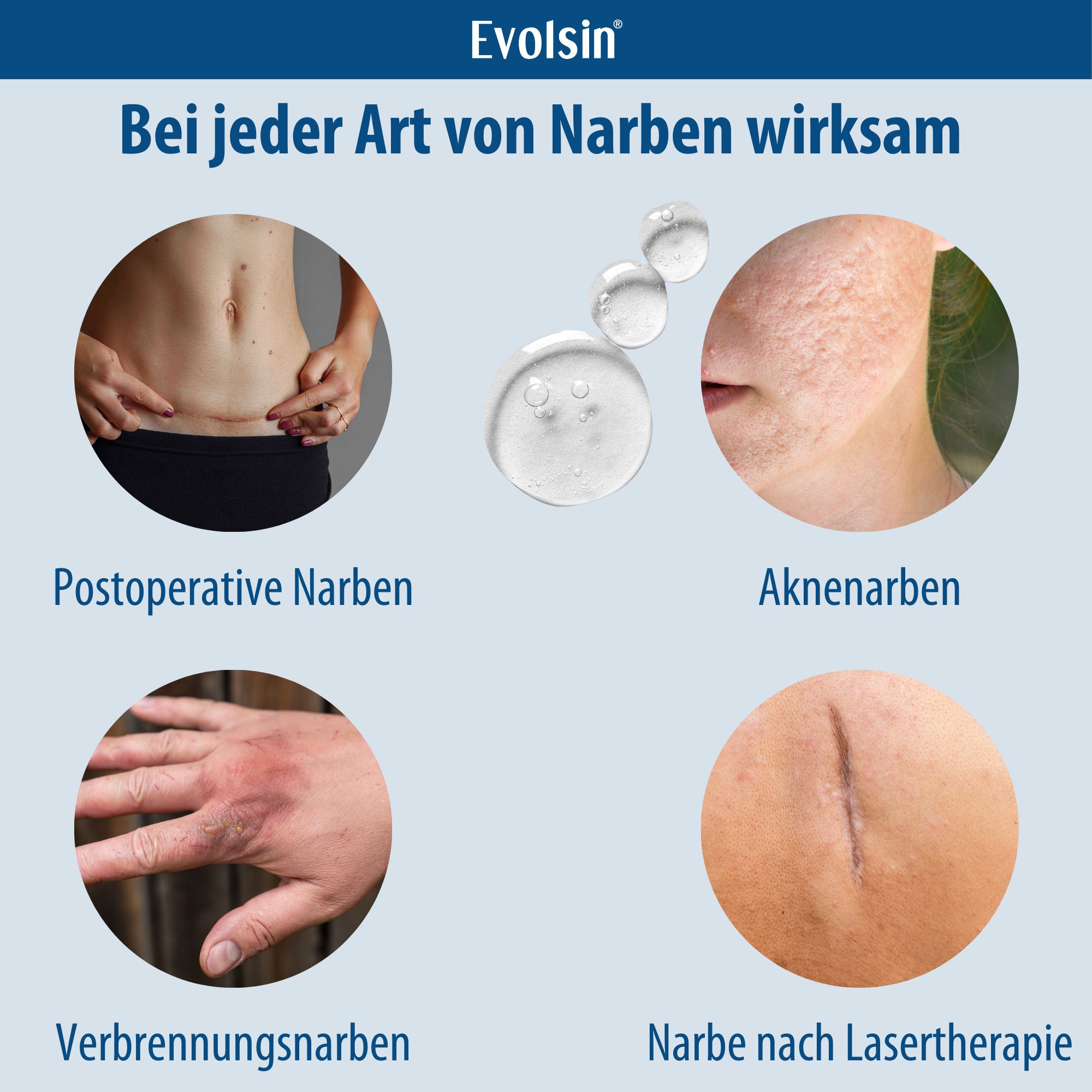 Afbeelding met soorten littekens: operatie, acne, brandwonden, laser.