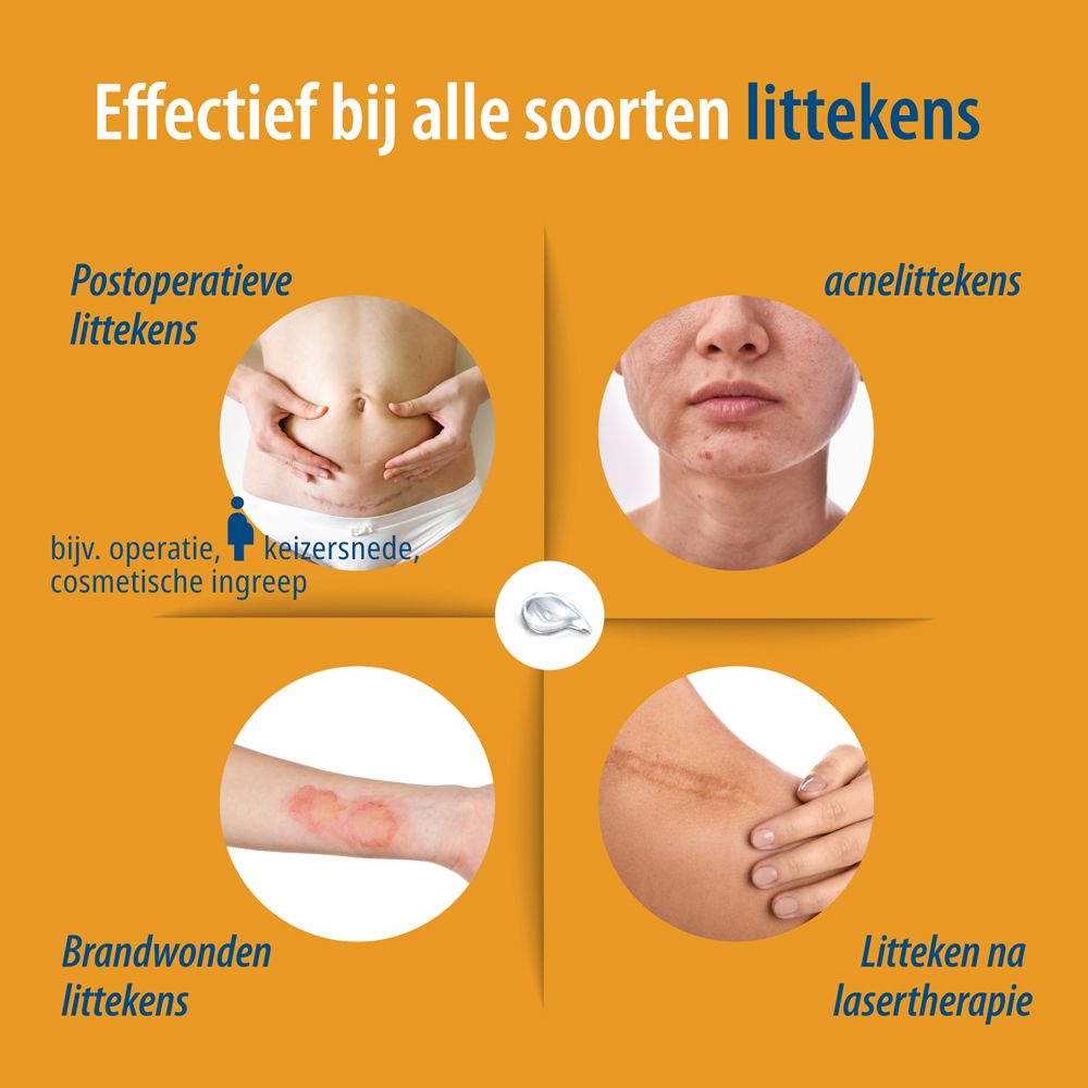 Arts toont voor/na vergelijking buik-litteken met Evolsin littekenvel.