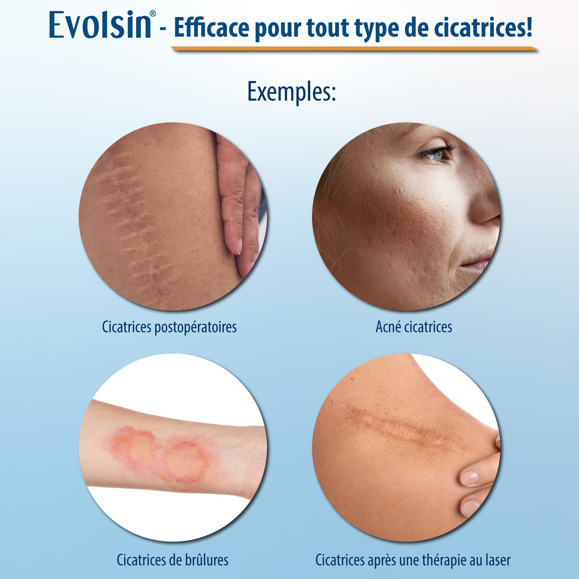 Exemples de cicatrices: opérations, césarienne, acné, hypertrophie, brûlures. Texte: Evolsin efficace sur toutes cicatrices.