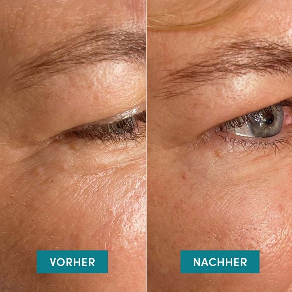 Voor-en-na vergelijking. Links: huid met rimpels. Rechts: gladdere huid. Product: Eye Temple Pads.