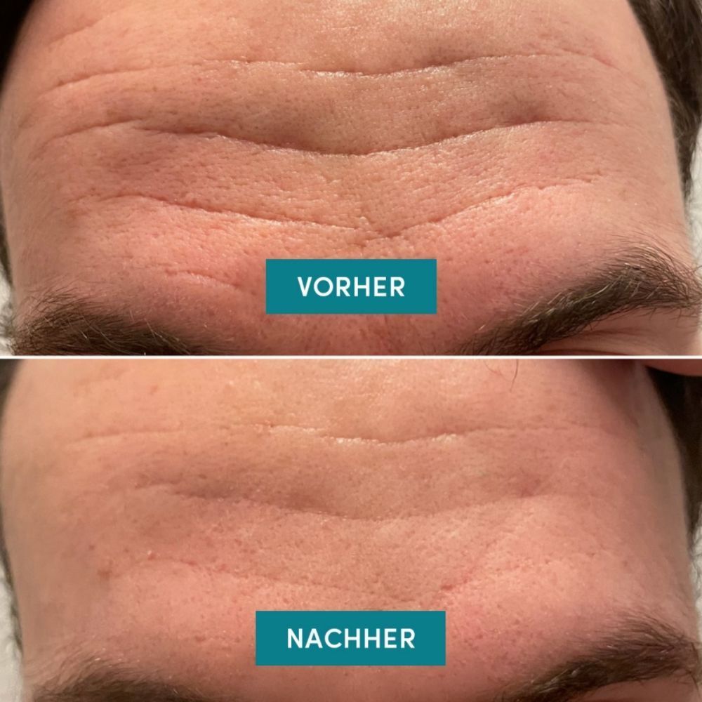 Voor-en-na vergelijking. Voorhoofd met rimpels. Na: gladdere huid. Tekst: Voor/Na.