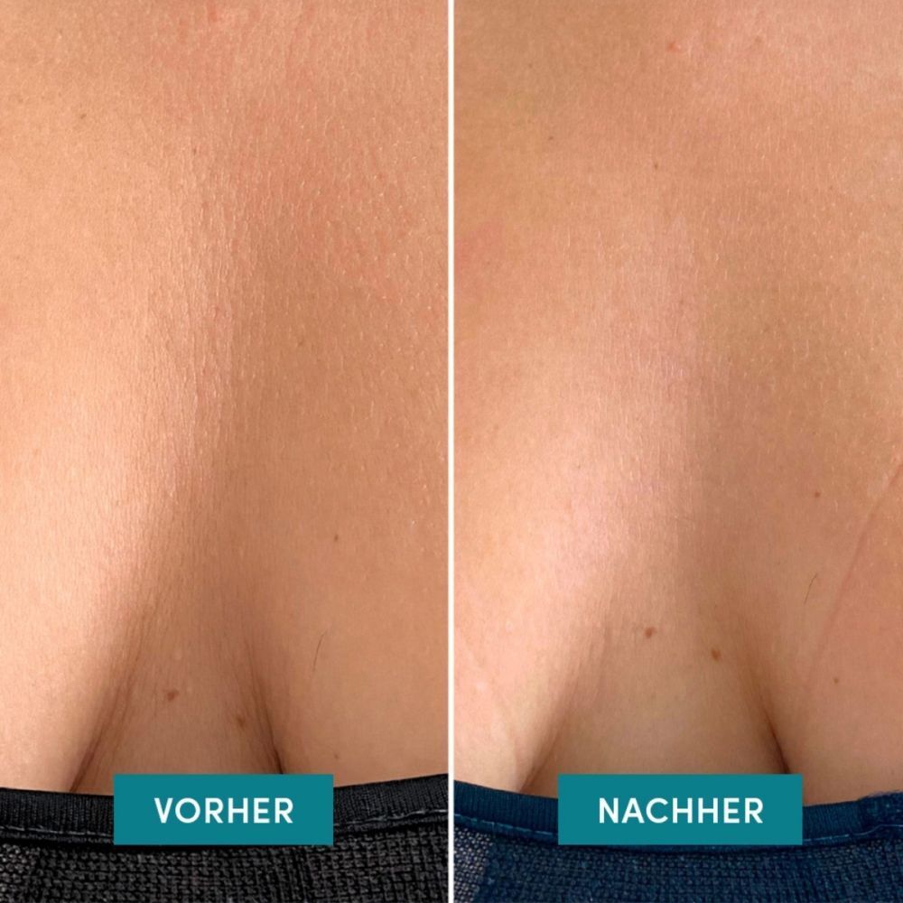 Deux gros plans sur la peau du décolleté. Gauche : Avant. Droite : Après. Barres bleues avec texte.