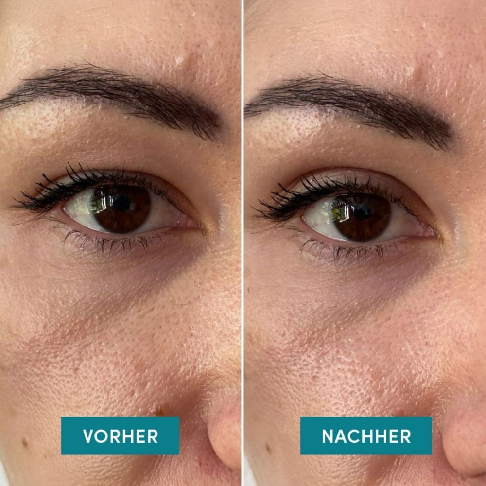 Deux yeux, 'AVANT' à gauche, 'APRÈS' à droite. Comparaison des états de la peau.