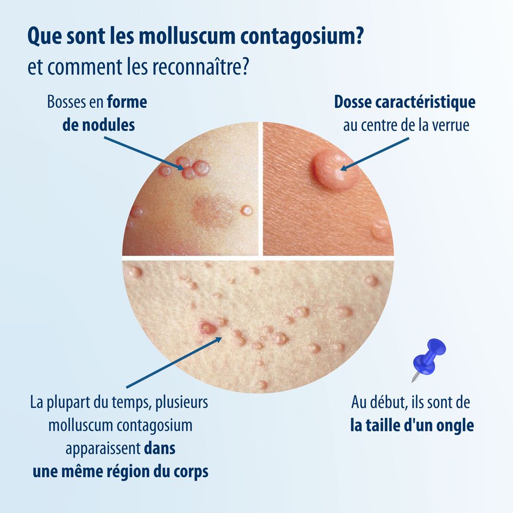 Emballage Evolsin® Solution molluscum contagiosum, illustration schématique.