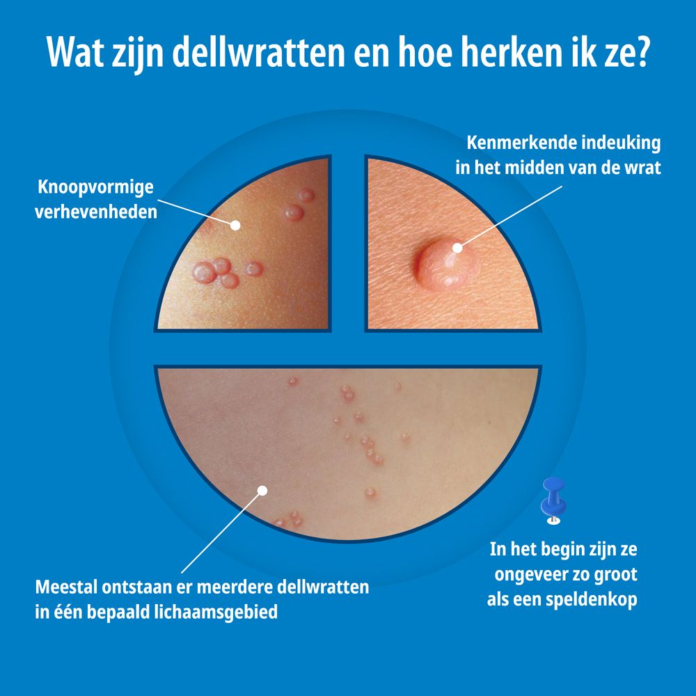 Verpakking Evolsin® Molluscum contagiosum treatment, schematische weergave.