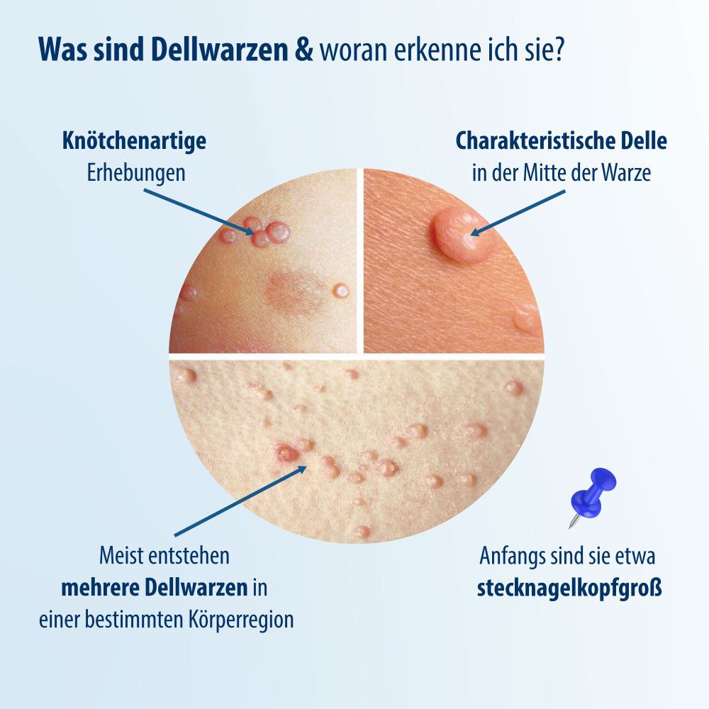 Cirkelvormige grafiek. Toont afbeeldingen van molluscum contagiosum. Bijschrift: Wat zijn molluscum contagiosum en hoe herken ik ze?